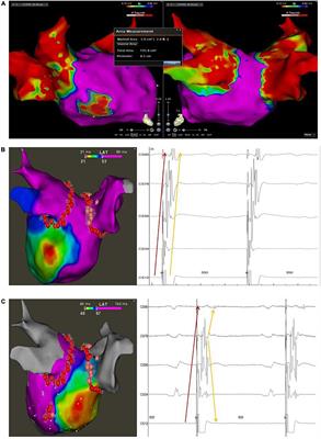 Assessing the impact of blocking distal coronary sinus-left atrial muscular connection on inducible rate of atrial fibrillation and follow-up recurrence in persistent atrial fibrillation patients with different fibrotic degrees of left atrial: A retrospective study